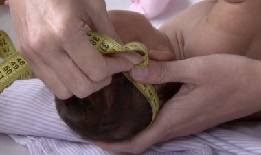 Crianças com síndrome congênita da zika têm mais chances de morrer