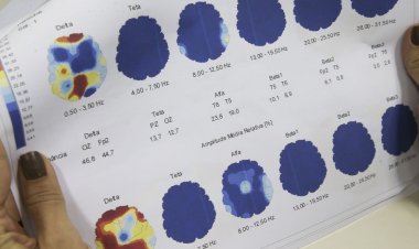 Março Roxo quer conscientizar população sobre a epilepsia