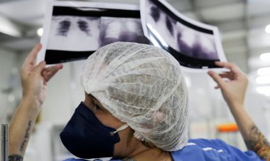 Médico alerta para riscos da tuberculose pulmonar não tratada