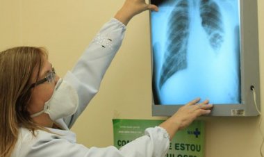 RJ, Acre e Amazonas lideram ranking de mortes por tuberculose no país