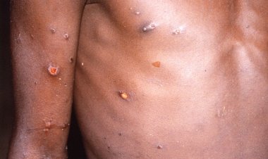 Portugueses publicam genoma do vírus da varíola dos macacos