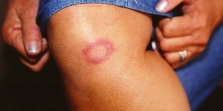 Hanseníase: marcas do preconceito é tema do Caminhos da Reportagem