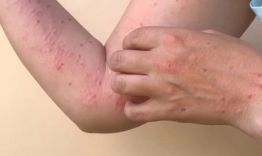 Secretaria de Saúde divulga caso de varíola dos macacos em Cataguases