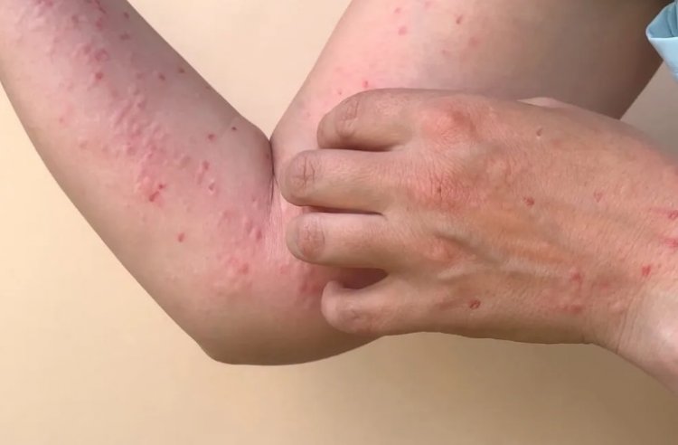 Secretaria de Saúde divulga caso de varíola dos macacos em Cataguases