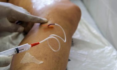 Doença venosa crônica é fator de risco para problemas cardiovasculares