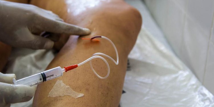 Doença venosa crônica é fator de risco para problemas cardiovasculares