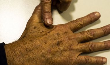 Brasil terá 704 mil novos casos de câncer por ano até 2025, diz Inca