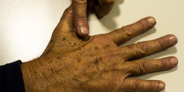 Sociedade médica lança campanha sobre prevenção do câncer de pele