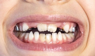 Centro de Especialidades Odontológicas de Ubá oferece tratamento para crianças com dentes desalinhados