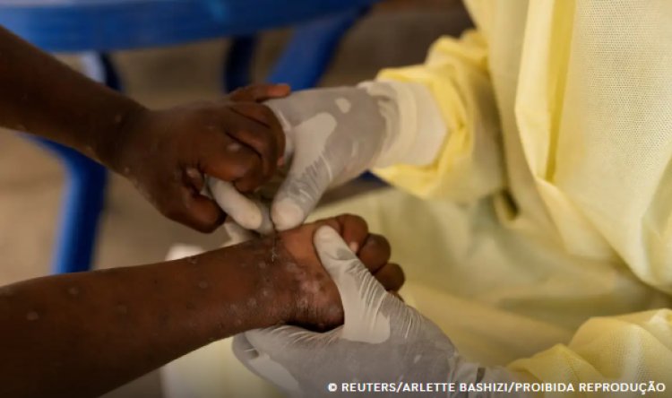 Saúde confirma primeiro caso de nova cepa de mpox no Brasil